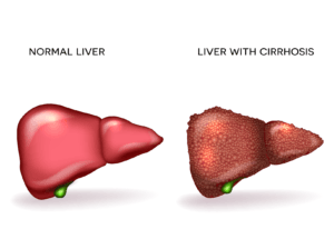 Cirrhosis