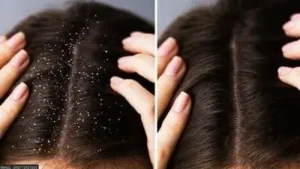 hair dandruff